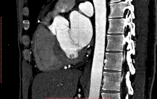 File:Anomalous left coronary artery from the pulmonary artery (ALCAPA) (Radiopaedia 70148-80181 C 125).jpg