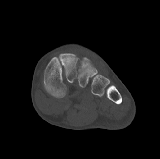 Anterior calcaneal process fracture (Radiopaedia 47384-51989 Coronal bone window 40).png