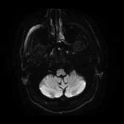 File:Anterior cerebral artery infarction (Radiopaedia 46794-51323 Axial DWI 6).jpg