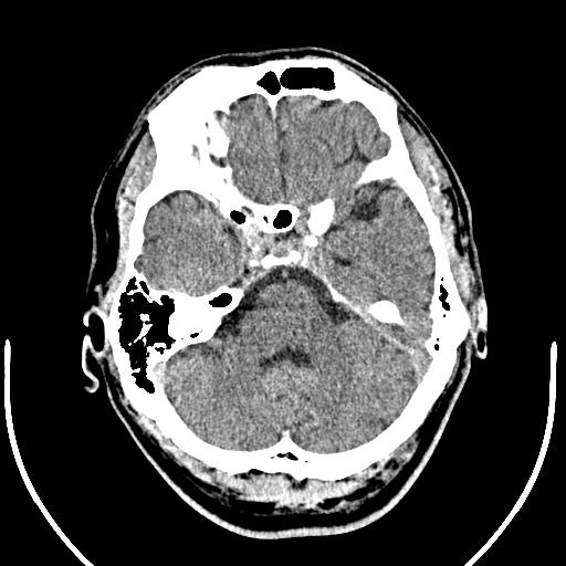 Anterior choroidal artery infarct (Radiopaedia 55106-61480 Axial non-contrast 13).jpg