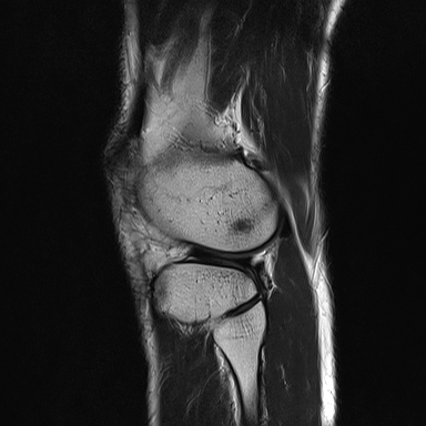 File:Anterior cruciate ligament full thickness tear (Radiopaedia 66268-75467 Sagittal T2 19).jpg