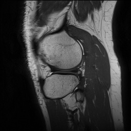 Anterior cruciate ligament rupture and posteromedial corner injury (Radiopaedia 67338-76723 Sagittal PD 132).jpg