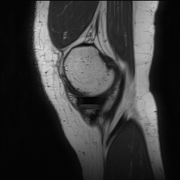 Anterior cruciate ligament rupture and posteromedial corner injury (Radiopaedia 67338-76723 Sagittal PD 33).jpg