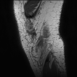 Anterior cruciate ligament rupture with Segond fracture (Radiopaedia 69043-78806 Sagittal PD 179).jpg