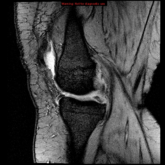 File:Anterior cruciate ligament tear (Radiopaedia 12329-12612 A 14).jpg