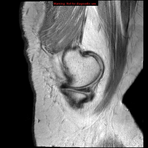 File:Anterior cruciate ligament tear (Radiopaedia 12329-12612 Sagittal T2 fat sat 18).jpg