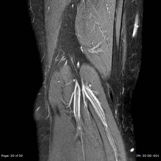 File:Anterior cruciate ligament tear (Radiopaedia 70783-80964 Coronal STIR 30).jpg