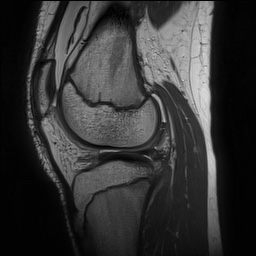 Anterior cruciate ligament tear - pediatric (Radiopaedia 62152-70260 Sagittal PD 112).jpg