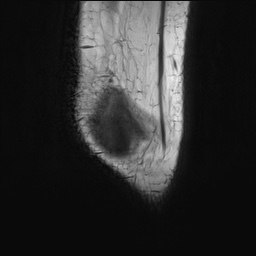 File:Anterior cruciate ligament tear - pediatric (Radiopaedia 62152-70260 Sagittal PD 17).jpg
