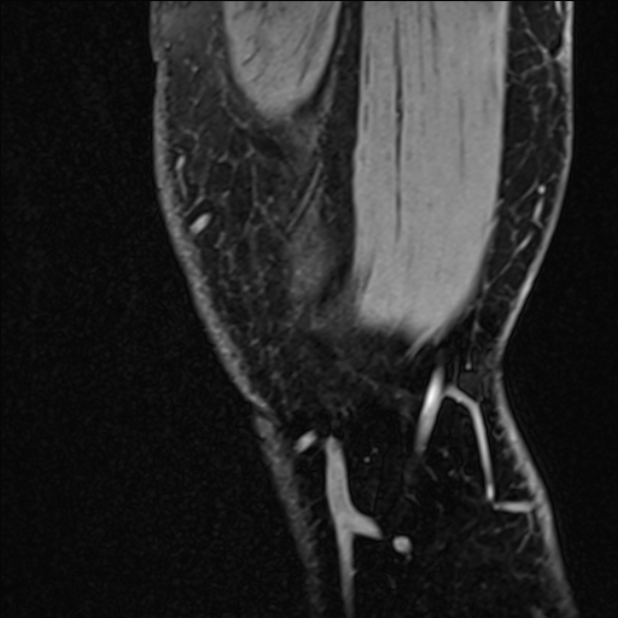 Anterior cruciate ligament tear - ramp lesion (Radiopaedia 71883-82322 Sagittal T1 vibe 135).jpg