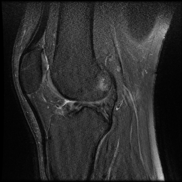 File:Anterior cruciate ligament tear with posteromedial corner injury, bucket-handle meniscal tear and chondral delamination (Radiopaedia 75501-86744 Sagittal PD fat sat 16).jpg