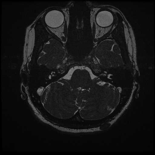Anterior inferior cerebellar artery vascular loop - type II (Radiopaedia 70991-81209 Axial 3D FIESTA 43).jpg