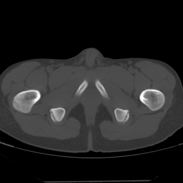Anterior inferior iliac spine avulsion fracture (Radiopaedia 49469-54627 Axial bone window 55).jpg