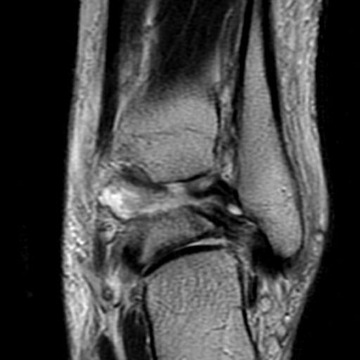 File:Anterior talofibular ligament rupture (Radiopaedia 15831-15484 Coronal T2 16).jpg