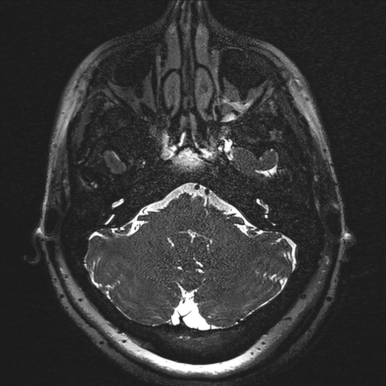 Anterior temporal encephalocele (Radiopaedia 82624-96808 Axial T2 high res 2).jpg