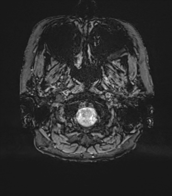 Anterior temporal pole cysts (Radiopaedia 46629-51102 Axial SWI 6).png