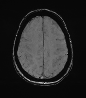 Anterior temporal pole cysts (Radiopaedia 46629-51102 Axial SWI 65).png