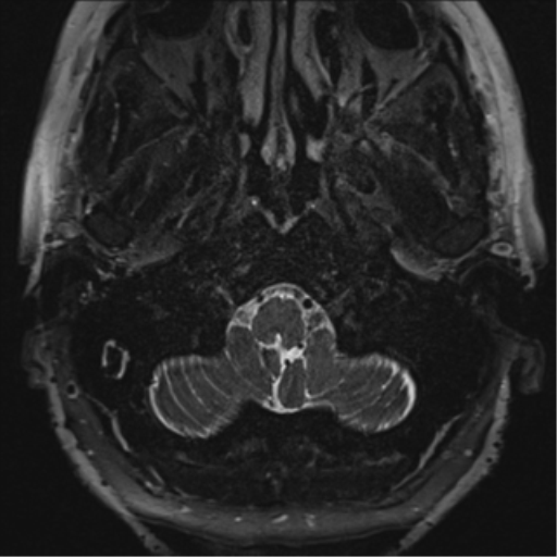 Anterior temporal pole cysts (Radiopaedia 46629-51102 Axial T2 2).png