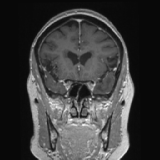 Anterior temporal pole cysts (Radiopaedia 46629-51102 Coronal T1 C+ 117).png