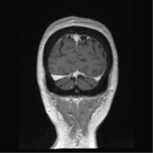 Anterior temporal pole cysts (Radiopaedia 46629-51102 Coronal T1 C+ 21).png