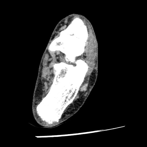 Anterior tibial artery false aneurysm (Radiopaedia 88984-105809 A 176).jpg