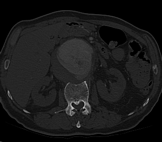 File:Anterior vertebral scalloping (abdominal aortic aneurysm) (Radiopaedia 66744-76067 Axial bone window 23).jpg