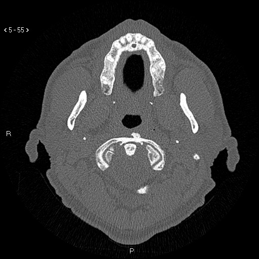 Antrochoanal Polyp (Radiopaedia 70510-80631 Axial bone window 3).jpg