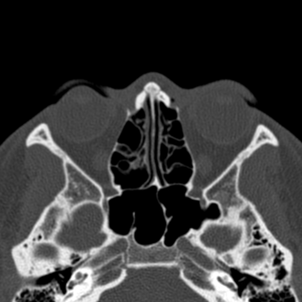 Antrochoanal polyp (Radiopaedia 33984-35202 Axial bone window 46).jpg
