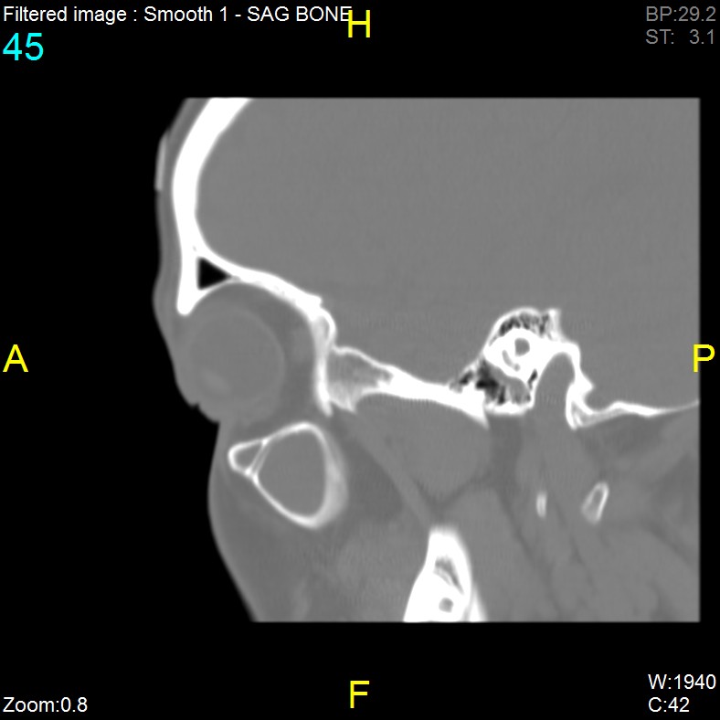 Antrochoanal polyp (Radiopaedia 65101-74094 Sagittal bone window 45).jpg