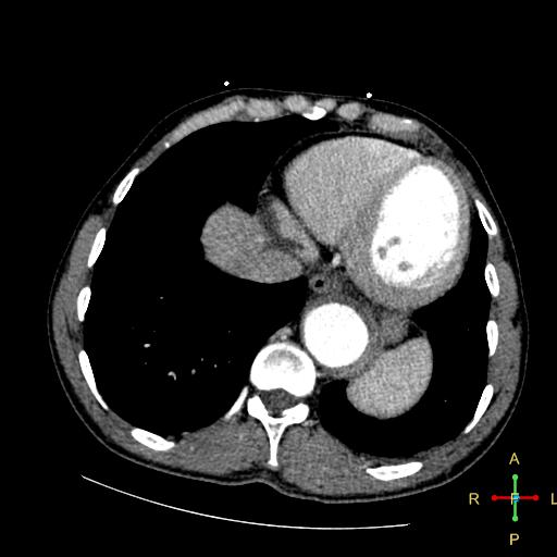 File:Aortic aneurysm and penetrating ulcer (Radiopaedia 23590-23704 A 25).jpg