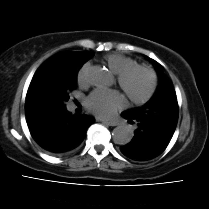 Aortic arch pseudoaneurysm (Radiopaedia 8534-9368 Axial non-contrast 43).jpg