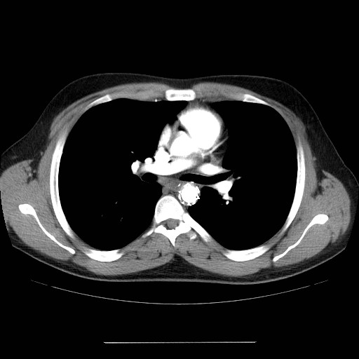 File:Aortic arch stent (Radiopaedia 30030-30595 D 17).jpg