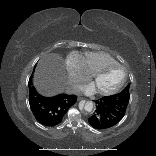 Aortic dissection- Stanford A (Radiopaedia 35729-37268 B 3).jpg