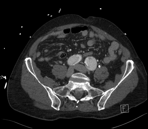 Aortic dissection (CTPA) (Radiopaedia 75506-86750 E 106).jpg