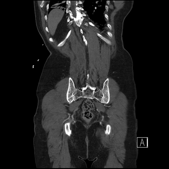 File:Aortic dissection (CTPA) (Radiopaedia 75506-86750 F 64).jpg