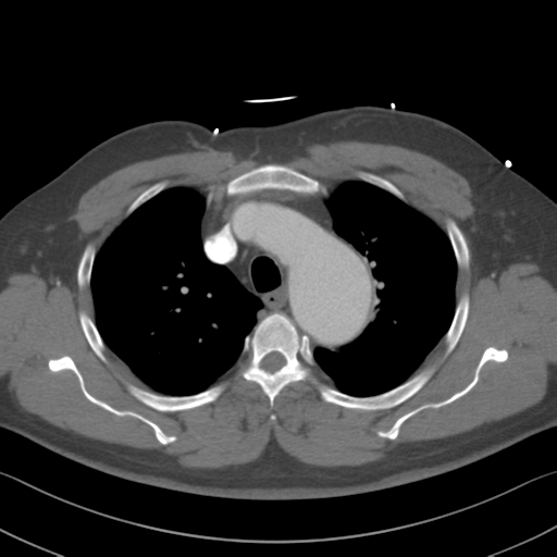 File:Aortic dissection (Radiopaedia 50763-56234 A 12).png