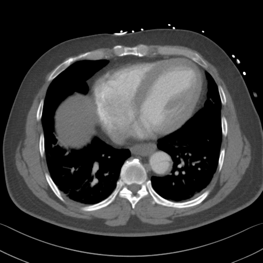 File:Aortic dissection (Radiopaedia 50763-56234 A 50).png