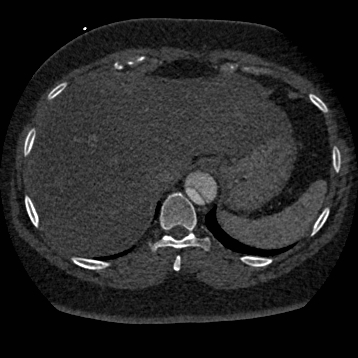 Aortic dissection (Radiopaedia 57969-64959 A 274).jpg