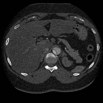 File:Aortic dissection (Radiopaedia 57969-64959 A 321).jpg