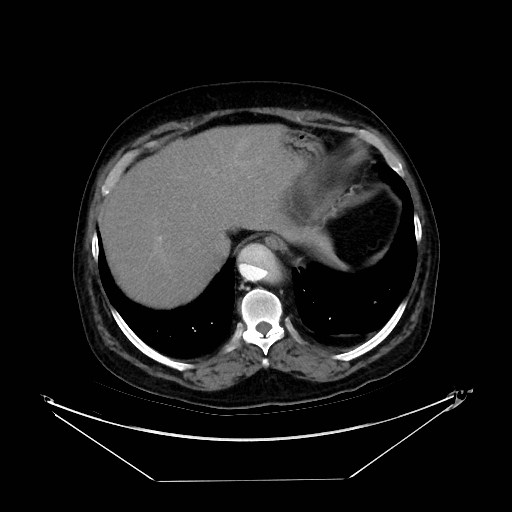 Aortic dissection (Radiopaedia 62562-71000 A 40).jpg