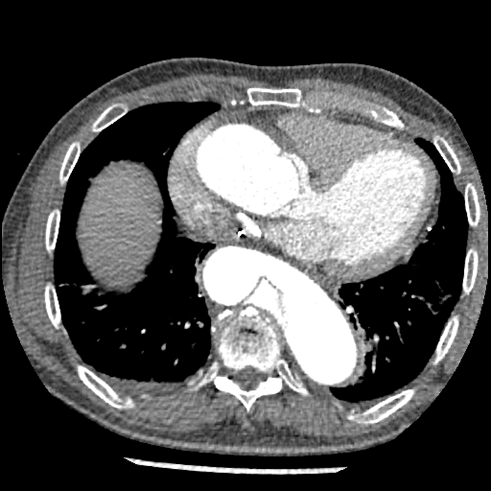 Aortic dissection - DeBakey Type I-Stanford A (Radiopaedia 79863-93115 A 26).jpg