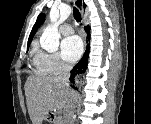 Aortic dissection - Stanford A -DeBakey I (Radiopaedia 28339-28587 C 20).jpg