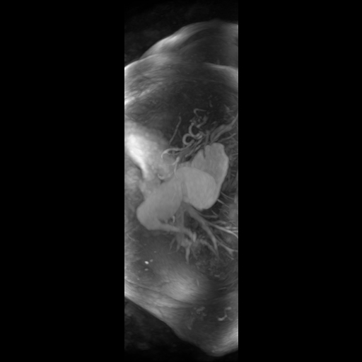 Aortic dissection - Stanford A - DeBakey I (Radiopaedia 23469-23551 D 12).jpg
