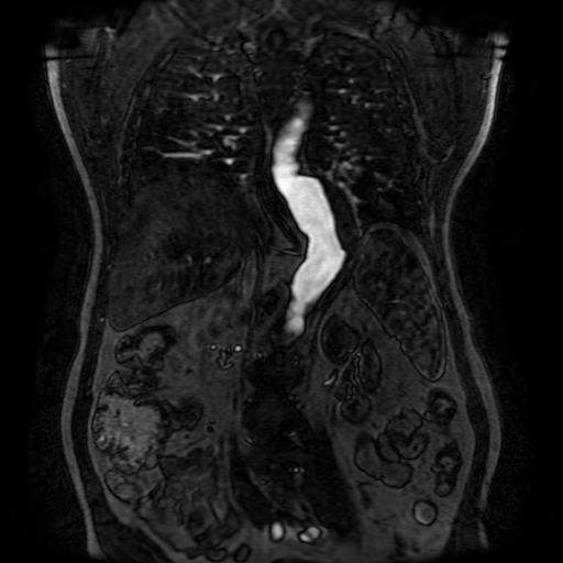Aortic dissection - Stanford A - DeBakey I (Radiopaedia 23469-23551 D 158).jpg