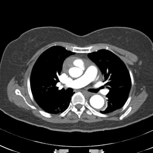 Aortic dissection - Stanford type A (Radiopaedia 39073-41259 A 34).png