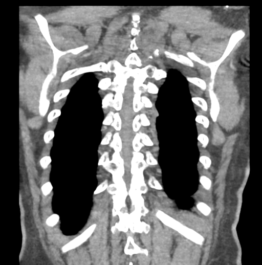Aortic dissection - Stanford type B (Radiopaedia 50171-55512 B 73).png