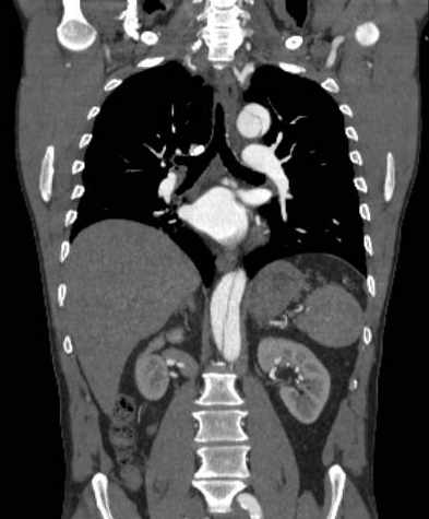 Aortic dissection - Stanford type B (Radiopaedia 73648-84437 B 69).jpg