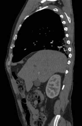 File:Aortic dissection - Stanford type B (Radiopaedia 73648-84437 C 116).jpg