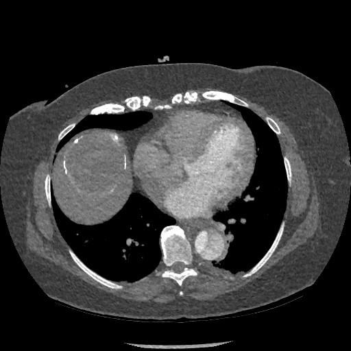Aortic dissection - Stanford type B (Radiopaedia 88281-104910 A 60).jpg