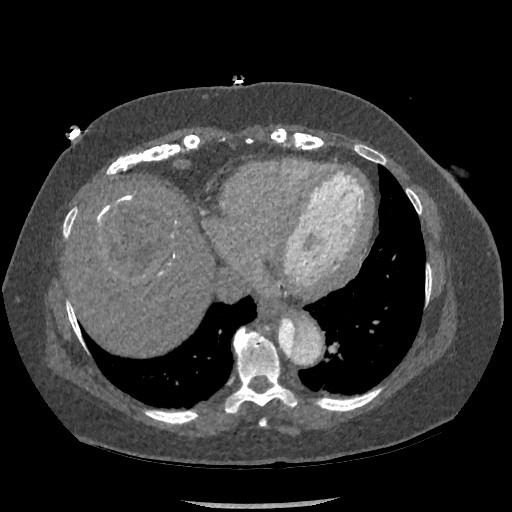 File:Aortic dissection - Stanford type B (Radiopaedia 88281-104910 A 69).jpg